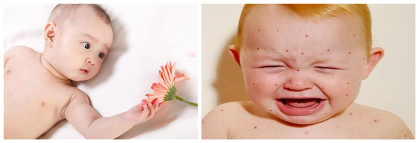 兒童濕疹反反復(fù)復(fù),您有在家安裝家用除濕產(chǎn)品嗎?